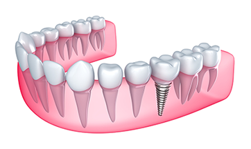 Cartoon of Dental Implants, East Lansing, MI